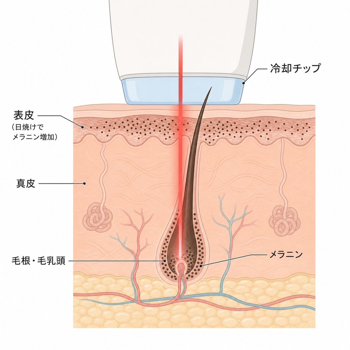 日焼けした表皮のメラニンがレーザーの熱を吸収しやすくなる仕組みを示す断面図