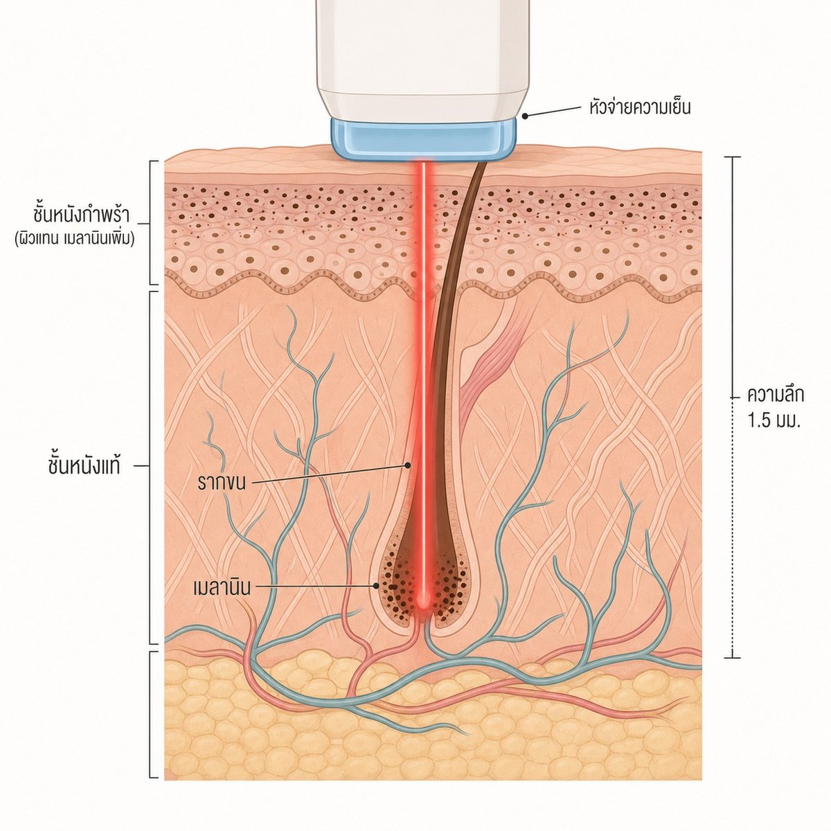 ภาพตัดขวางแสดงว่าเมลานินบนผิวแทนดูดซับความร้อนจากเลเซอร์ได้ง่ายขึ้น