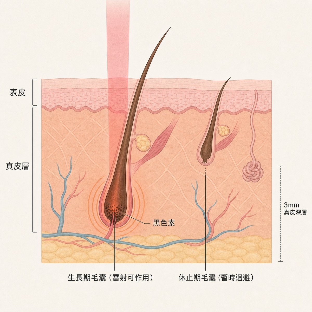 雷射除毛作用於生長期毛囊示意圖，休止期毛囊因無黑色素活躍而暫時迴避