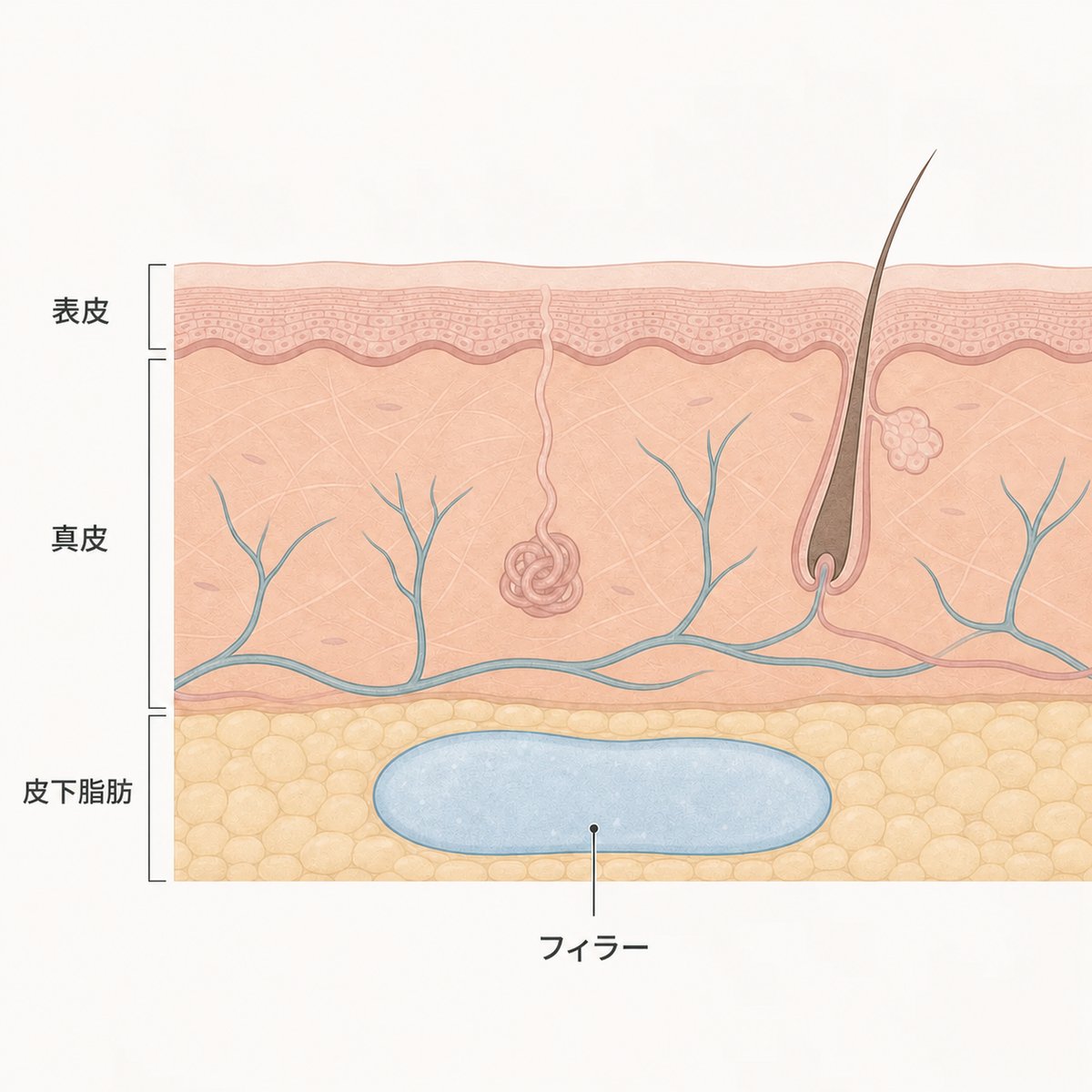 皮膚下の脂肪層に定着するフィラー