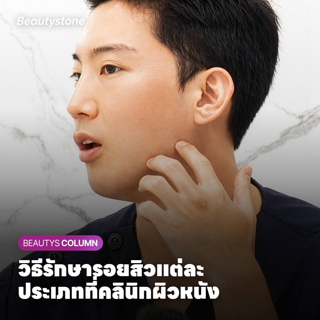 วิธีรักษารอยสิวแต่ละประเภทที่คลินิกผิวหนัง