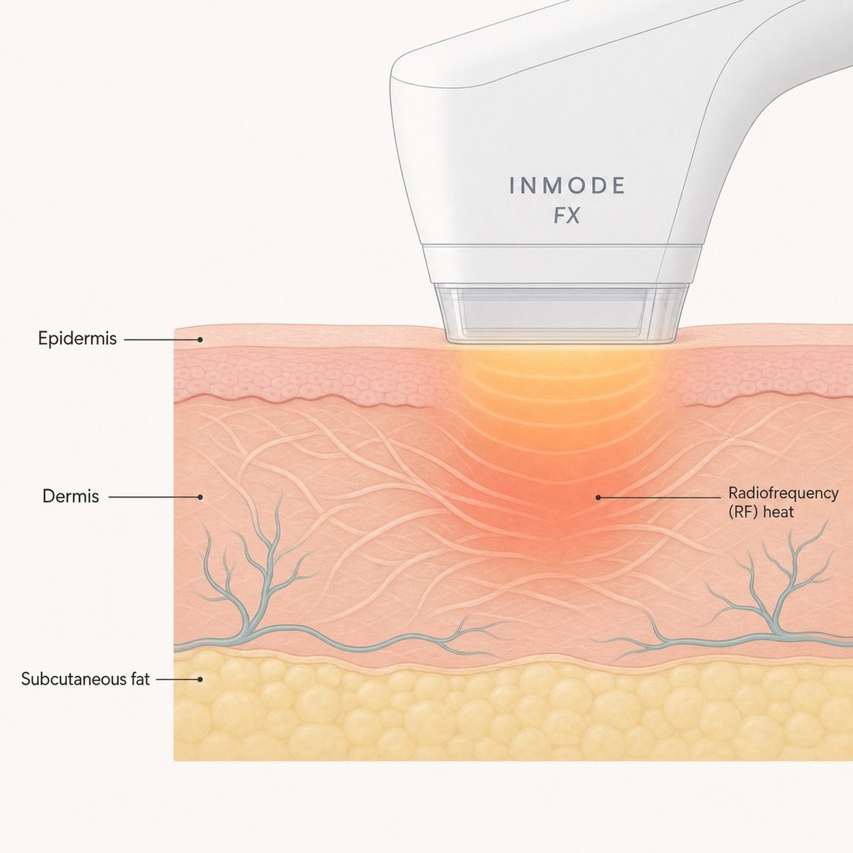 Cross-section showing InMode FX sending RF heat into the dermis without wounding the surface