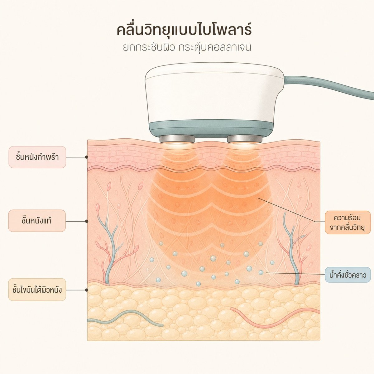 ภาพตัดขวางแสดงความร้อนจากคลื่นวิทยุที่ลงถึงชั้นหนังแท้และไขมันใต้ผิวหนัง พร้อมน้ำคั่งชั่วคราว