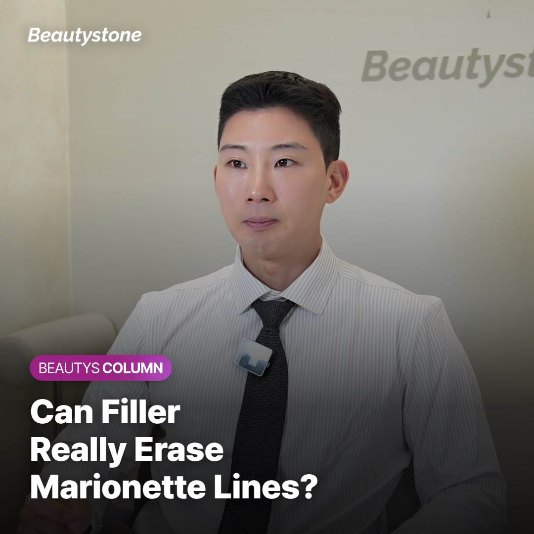 Will Filling the Marionette Lines With Filler Make Them Disappear?