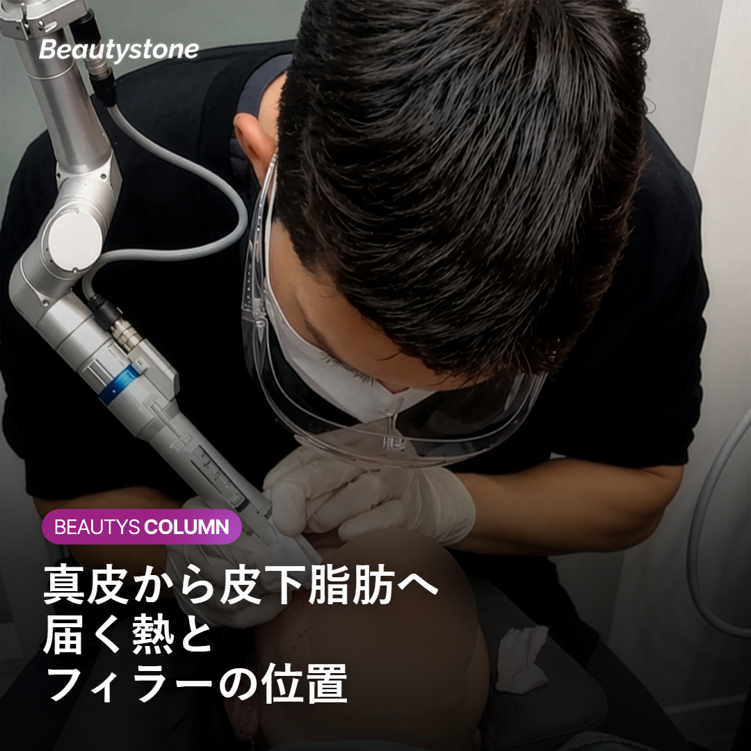 オリジオXの熱が真皮から皮下脂肪層へ届く経路とフィラーの位置のイメージ