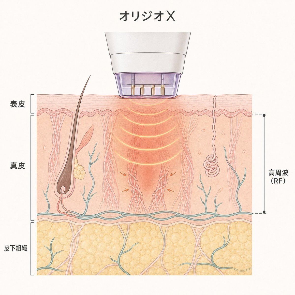 オリジオXの高周波が額の真皮に熱を届ける仕組みを示す図