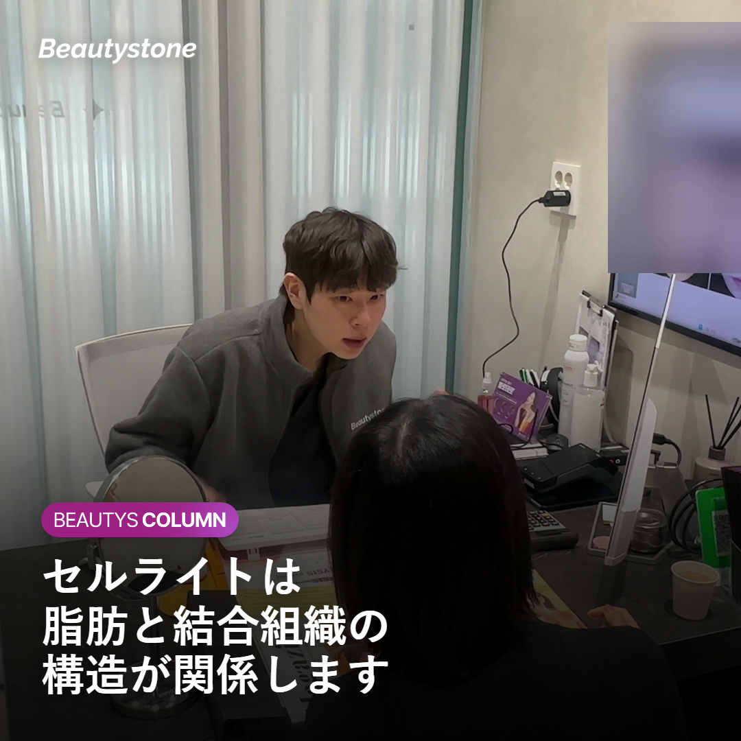 セルライトが脂肪と結合組織の構造で生じることを示す図