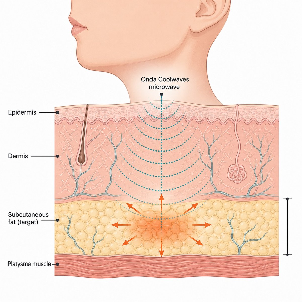 Diagram showing how Onda Coolwaves microwave energy penetrates to the subcutaneous fat layer under the chin while sparing the skin surface