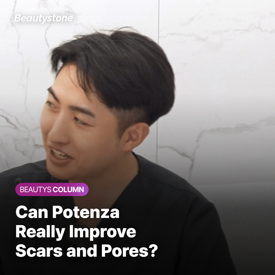 Does Potenza Really Help Reduce Acne Scars and Enlarged Pores?