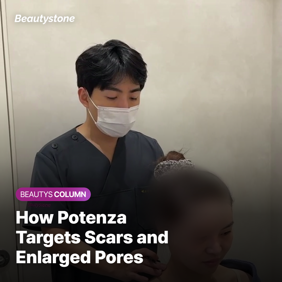 How Potenza works on scars and pores