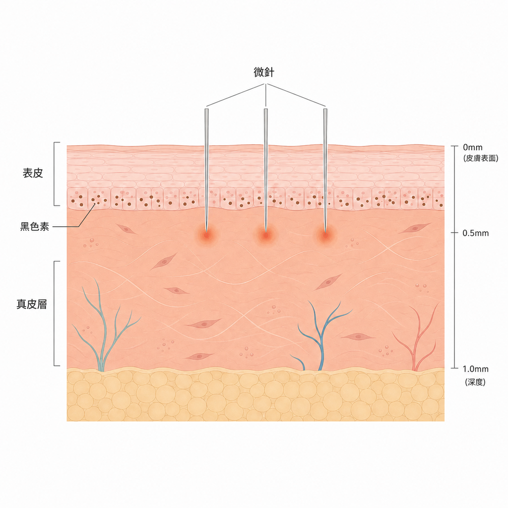 表皮的黑色素與微針到達的深度