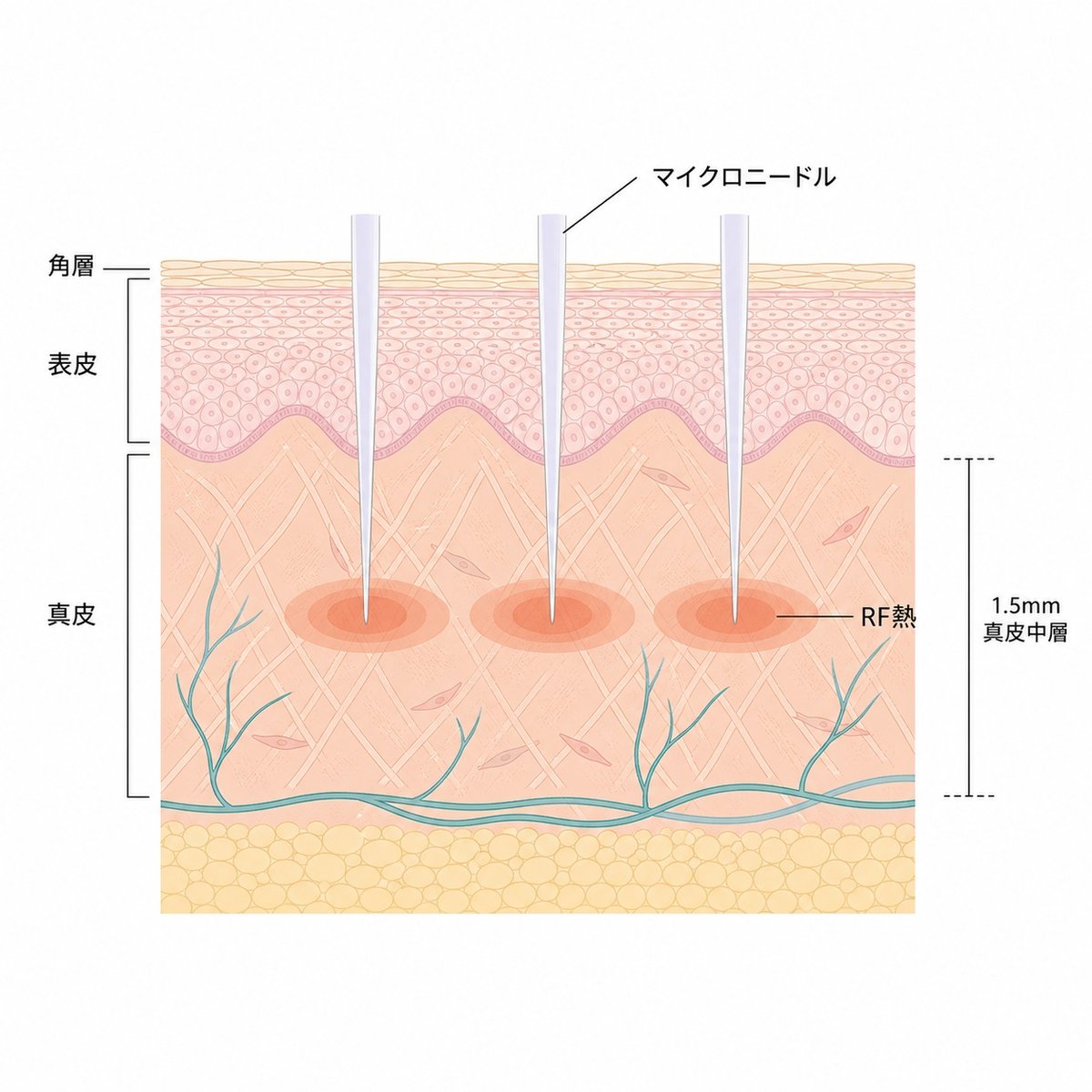 ポテンツァの極細針が角層を通って真皮に届きRF熱を伝える断面イラスト