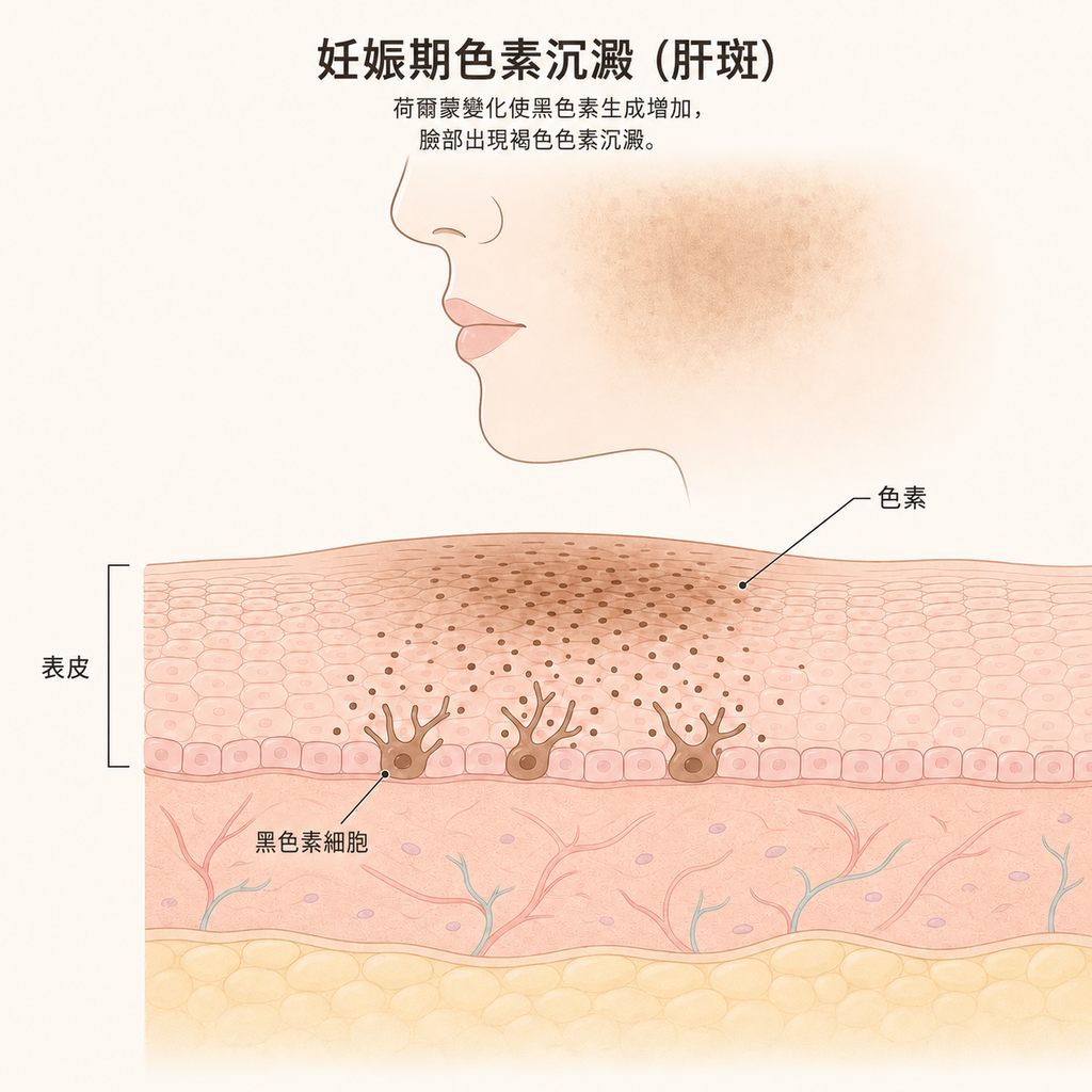 懷孕期間黑色素細胞活躍、色素浮現的示意圖