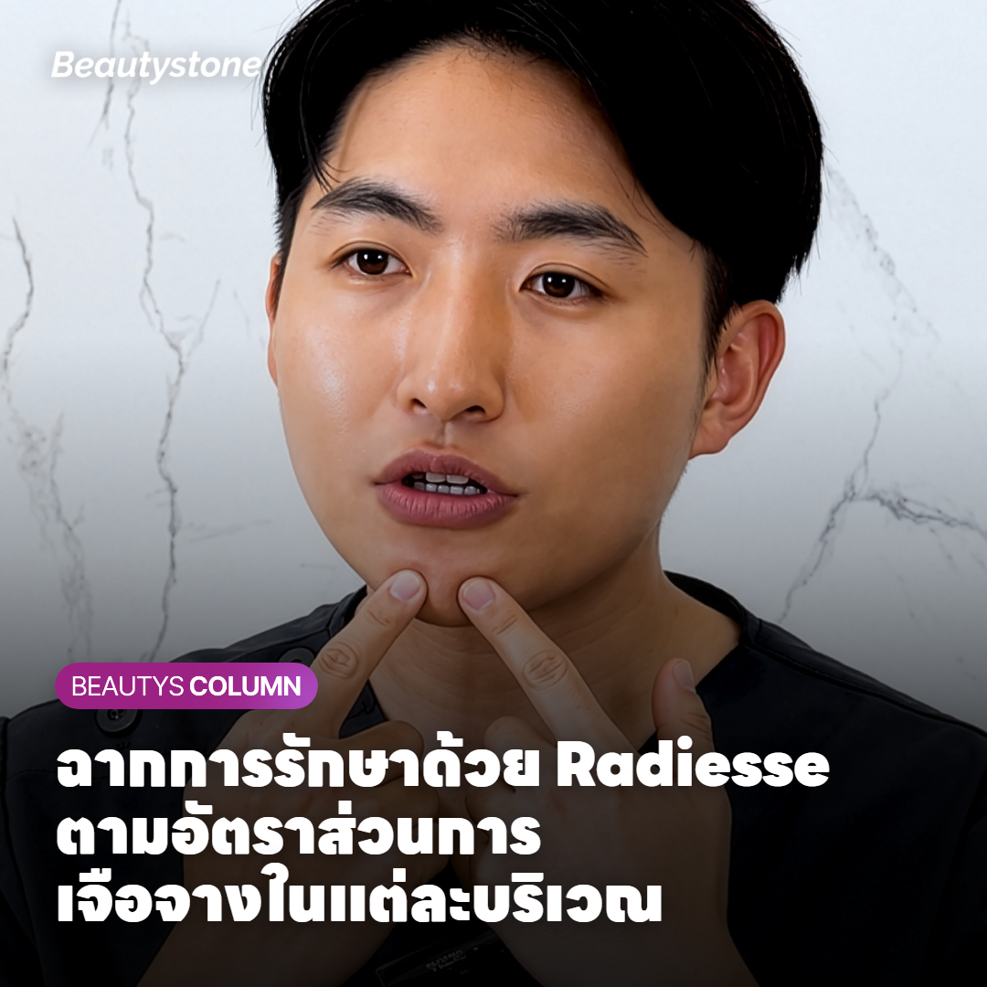 ฉากการรักษาด้วย Radiesse ตามอัตราส่วนการเจือจางในแต่ละบริเวณ