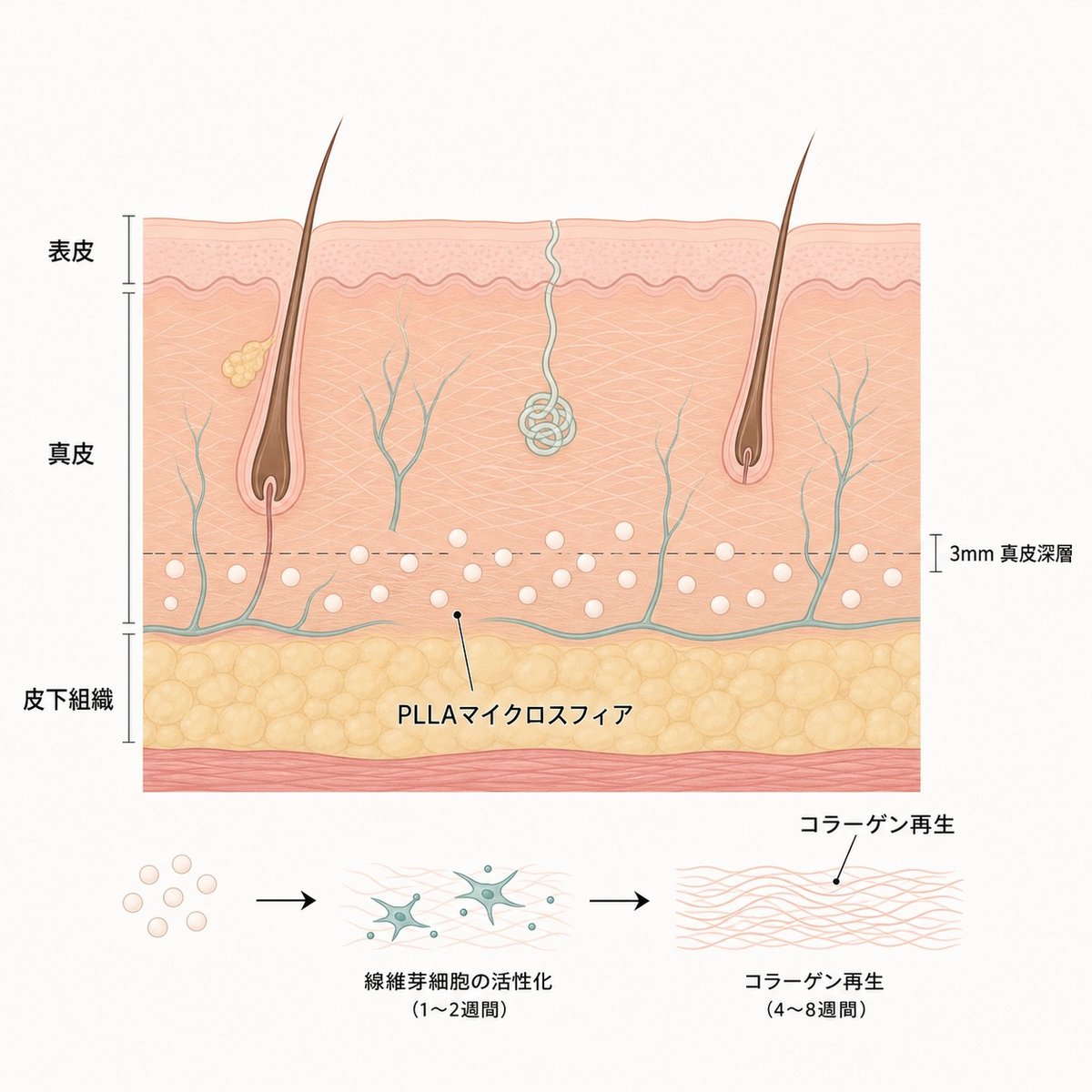 首の皮膚断面図：PLLA注入後のコラーゲン増生プロセス
