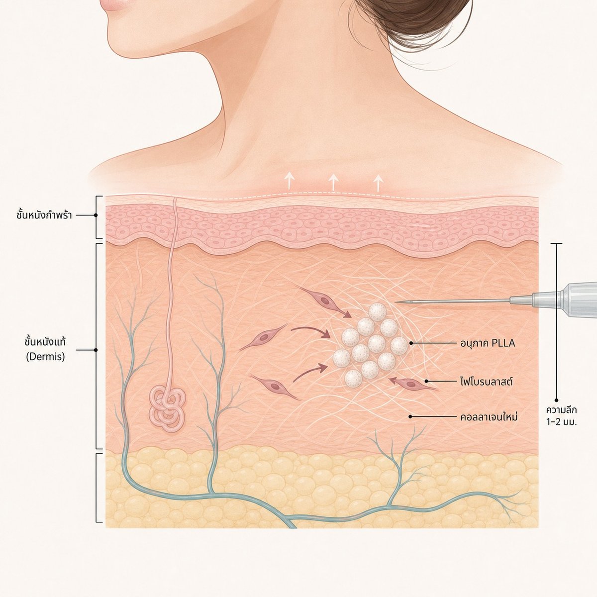 หลักการทำงานของ Sculptra ในชั้นผิวบริเวณคอ — PLLA กระตุ้นไฟโบรบลาสต์สร้างคอลลาเจน