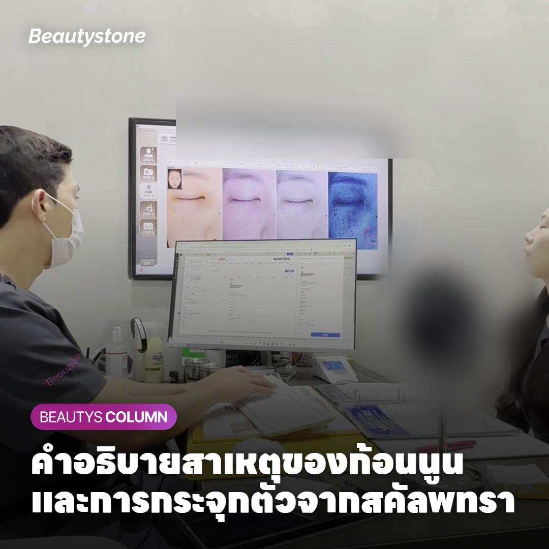 คำอธิบายสาเหตุของก้อนนูนและการกระจุกตัวจากสคัลพทรา