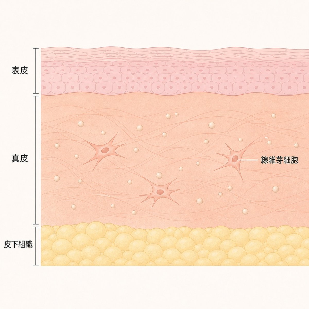 真皮に残った微粒子のまわりで線維芽細胞がコラーゲンをつくる様子の断面図