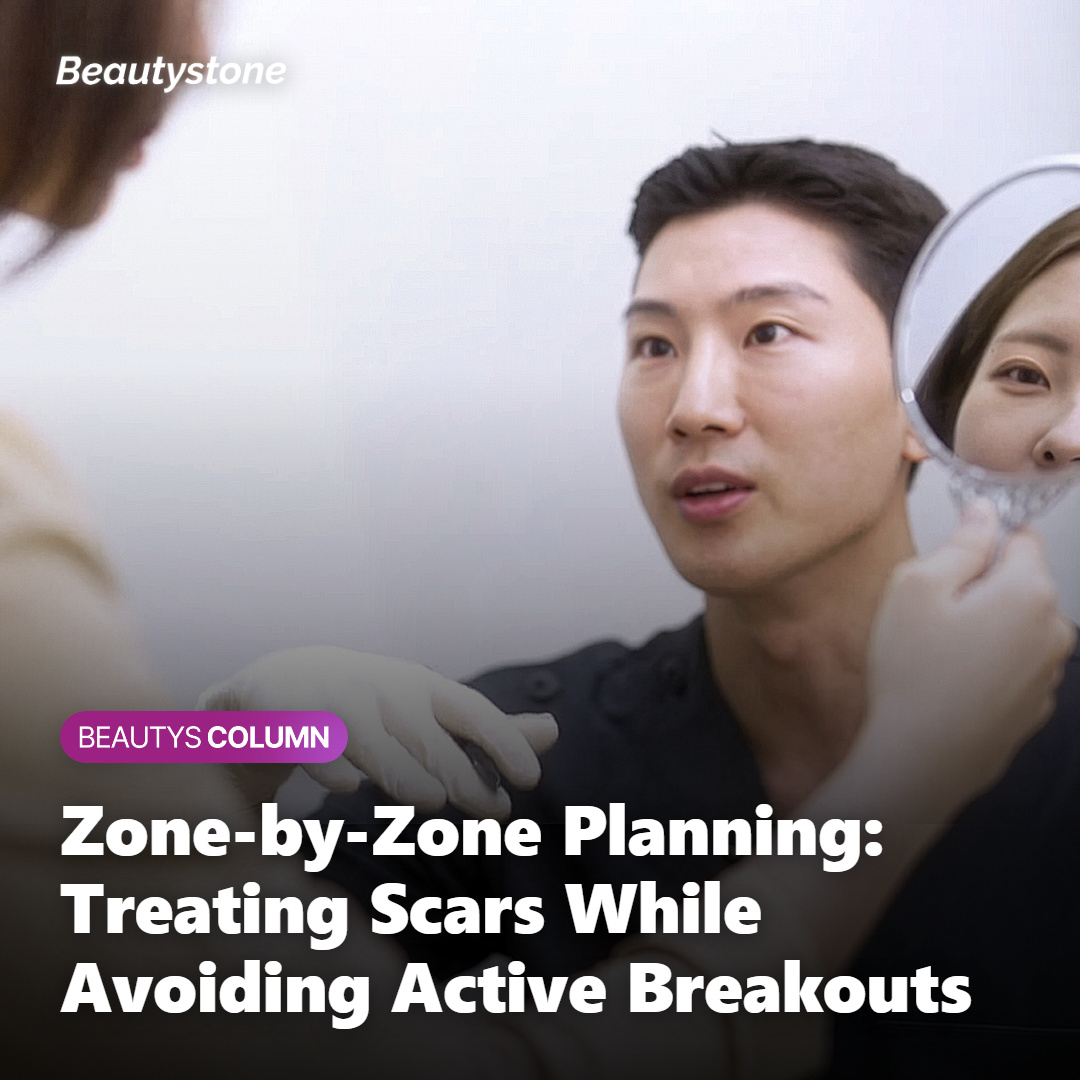 Provider mapping facial zones before Secret RF to design treatment around active acne lesions