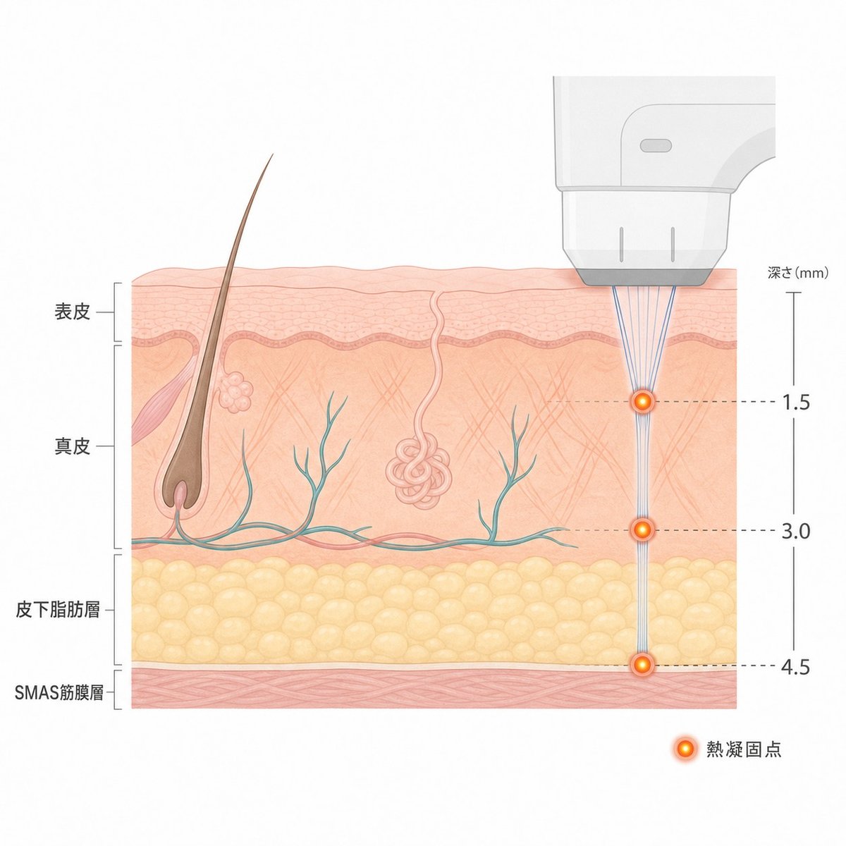 シュリンクユニバースの超音波が皮膚の各層に届く仕組みを示した断面図
