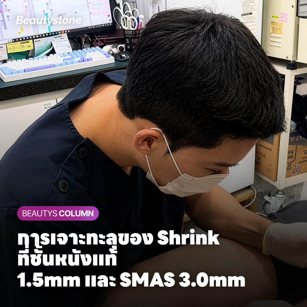 การเจาะทะลุของ Shrink ที่ชั้นหนังแท้ 1.5mm และ SMAS 3.0mm
