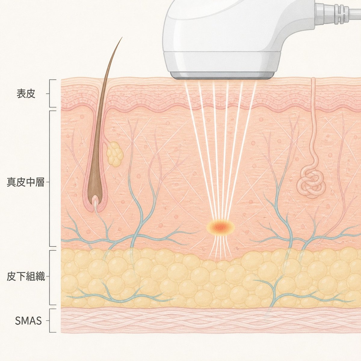 ソフウェーブの熱が真皮中層に届く深さを示した皮膚断面のイラスト