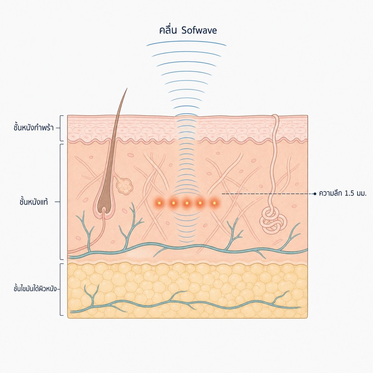 ภาพตัดขวางแสดงคลื่นอัลตราซาวด์ Sofwave ที่ลงไปกระตุ้นคอลลาเจนในชั้นหนังแท้ระดับกลาง