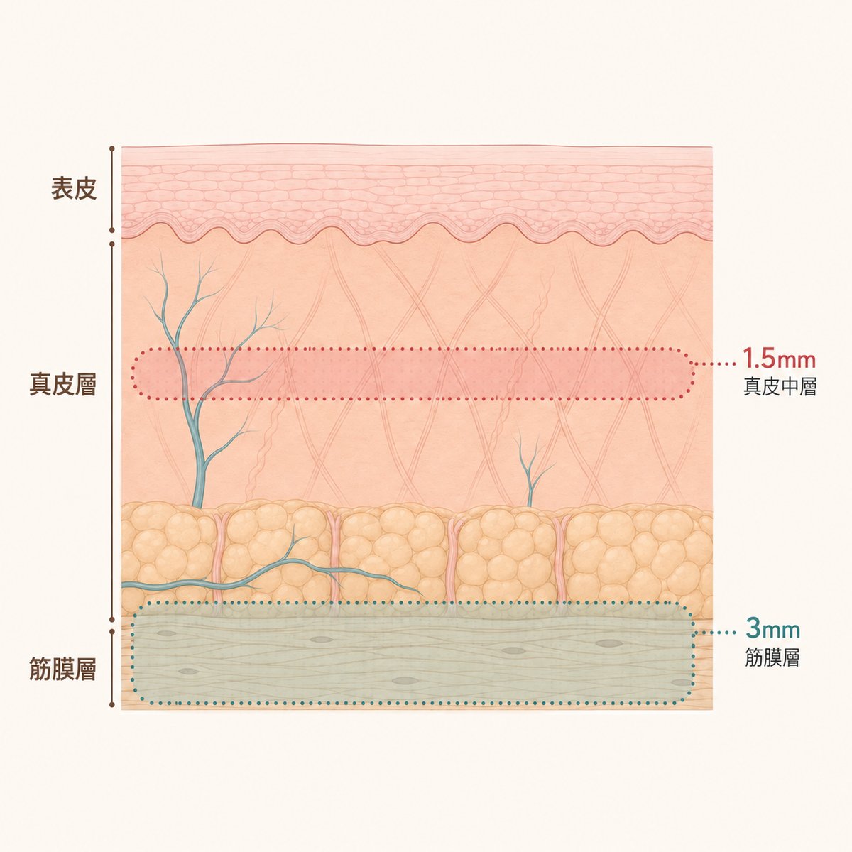 真皮中間層與深層筋膜層，超音波作用深度各有不同