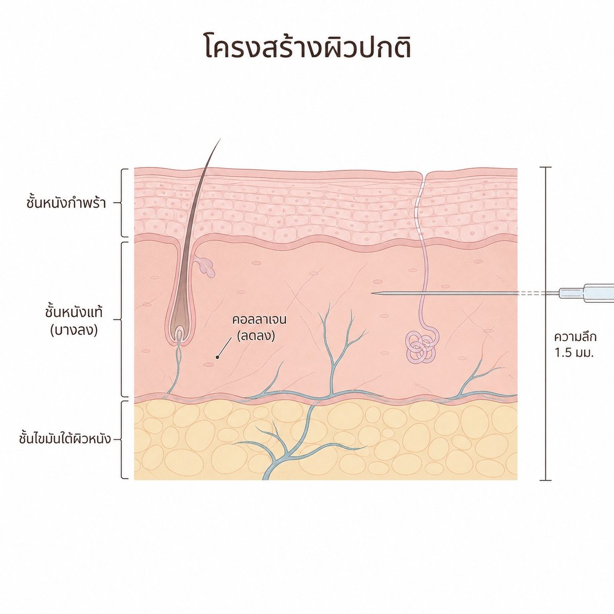 แผนภาพแสดงชั้นผิวหนังที่บางลงหลังใช้สเตียรอยด์ทาเฉพาะที่ในระยะยาว เปรียบเทียบกับผิวปกติ