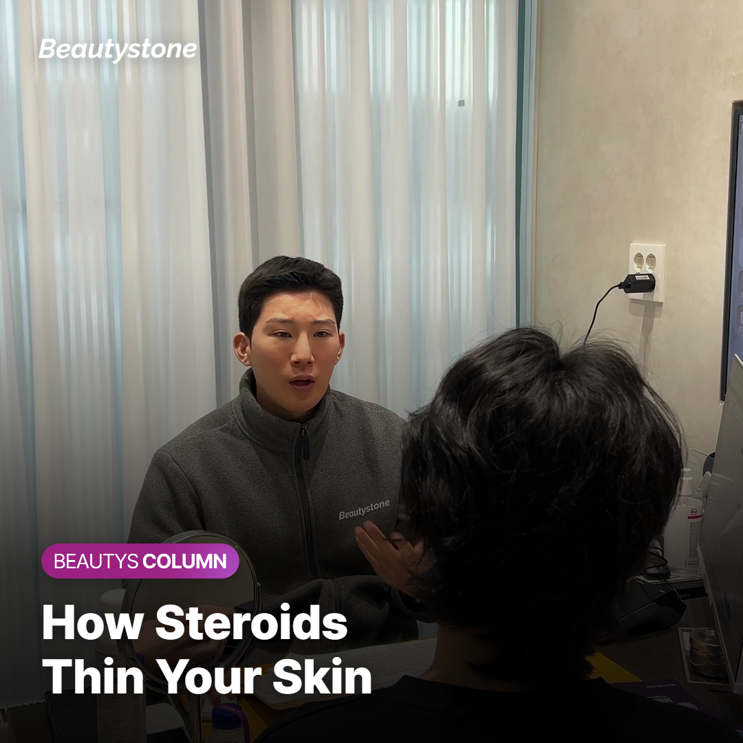 Illustration of filler injection technique adjusted for thinner steroid-affected dermis