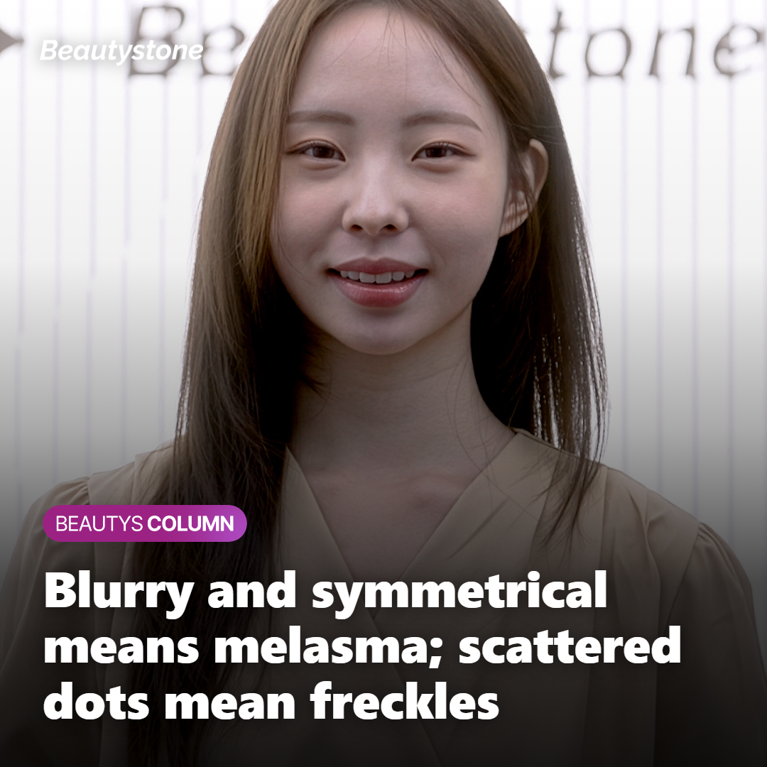 Illustration comparing blurry symmetrical melasma with scattered freckles