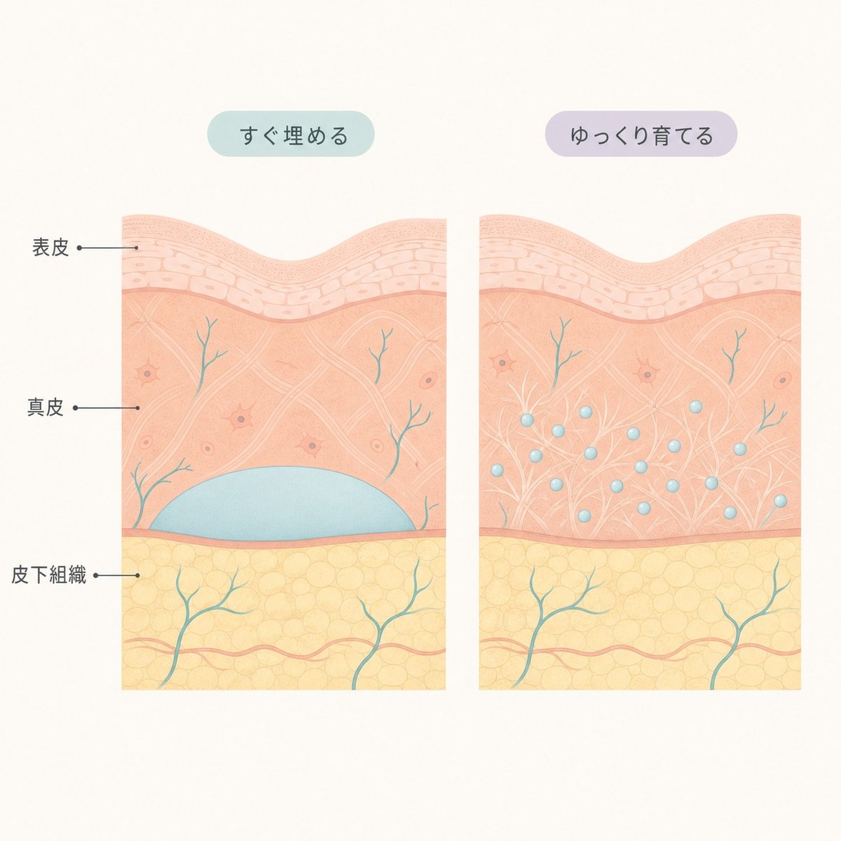 こめかみのボリュームを戻す二つの方法を並べた断面図。すぐ埋める方法とゆっくり育てる方法の違いを示している