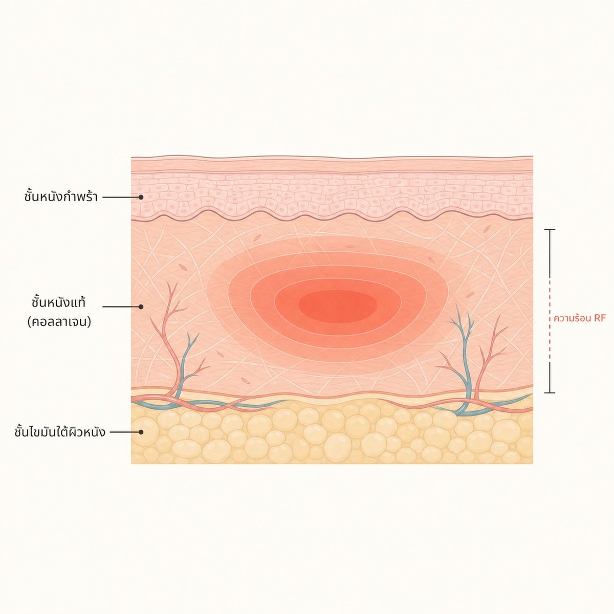 ภาพตัดขวางแสดงคลื่น RF ของ Thermage ที่ให้ความร้อนในชั้นหนังแท้ ไม่ลงไปถึงชั้นไขมัน