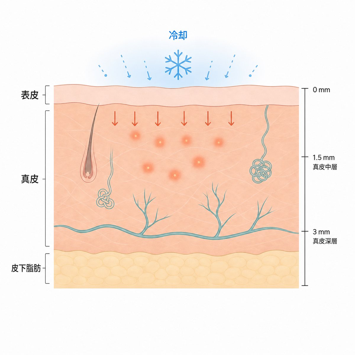 表面を冷却で守りつつ、真皮の層にだけ熱を届ける流れ
