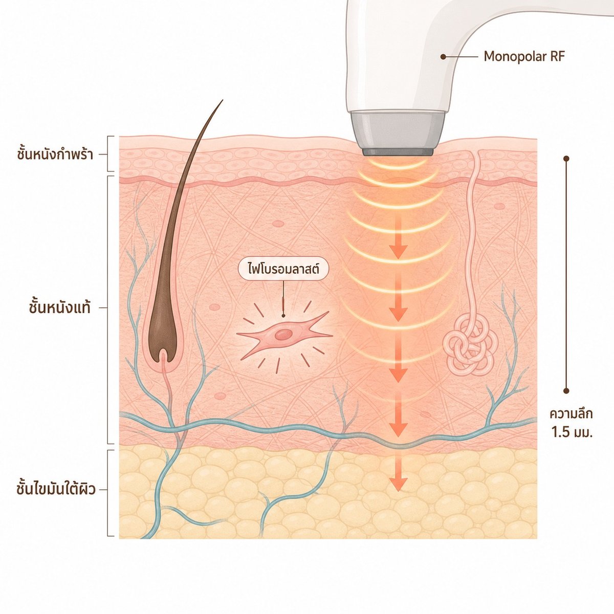 แผนภาพการทำงาน Thermage FLX