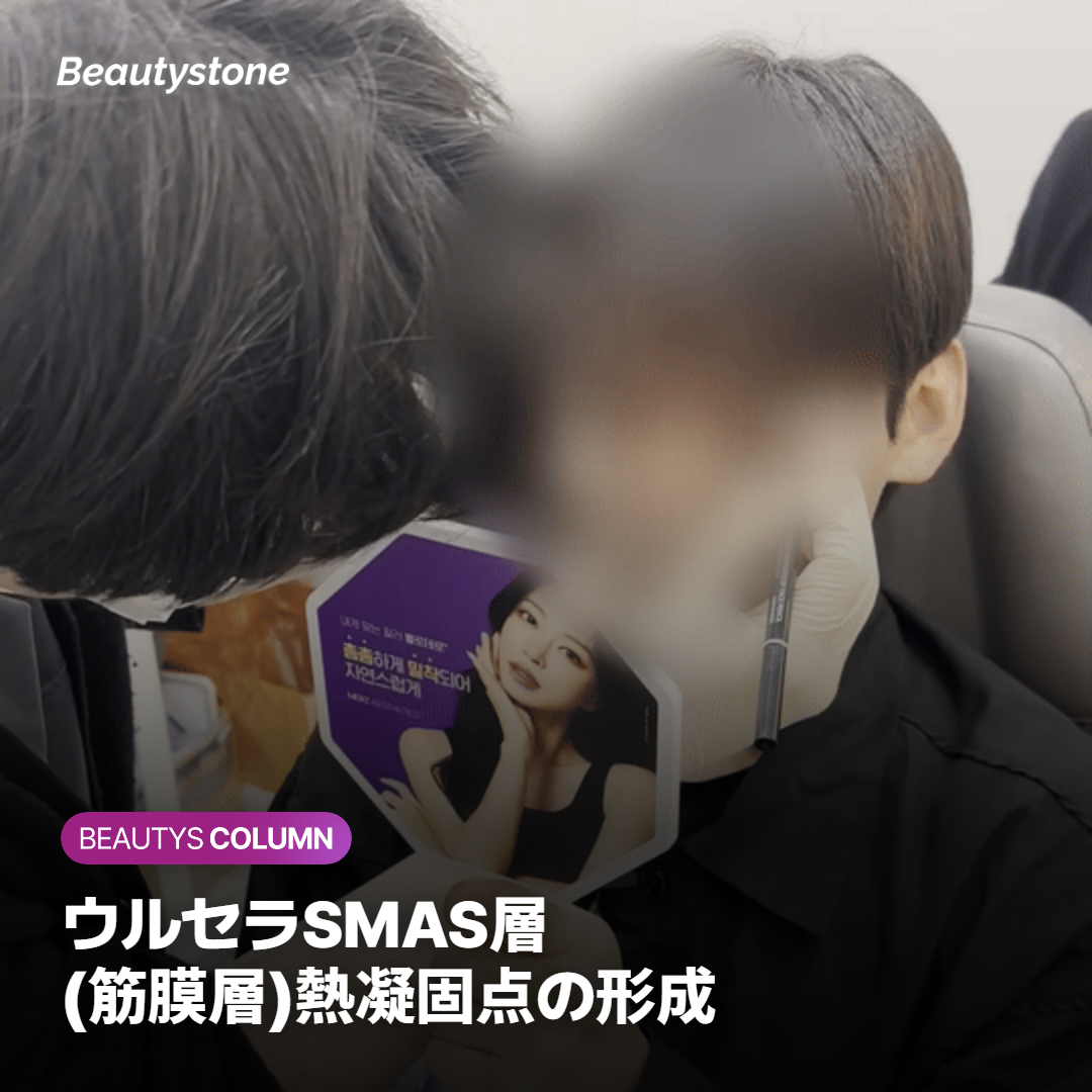 ウルセラSMAS層 (筋膜層)熱凝固点の形成