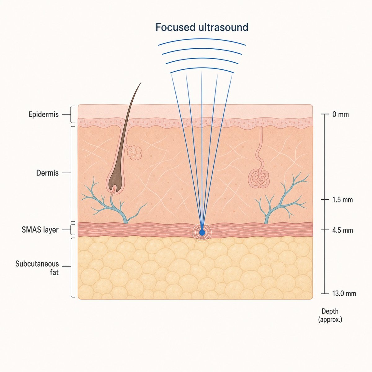 Cross-section showing Ultherapy PRIME focused ultrasound reaching the deep SMAS layer