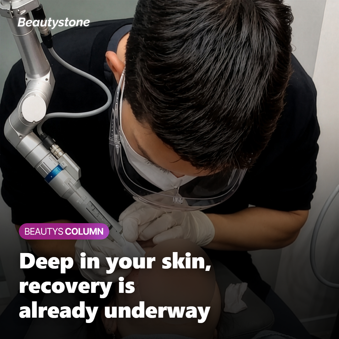 Illustration of Ultherapy PRIME ultrasound reaching the deep SMAS layer
