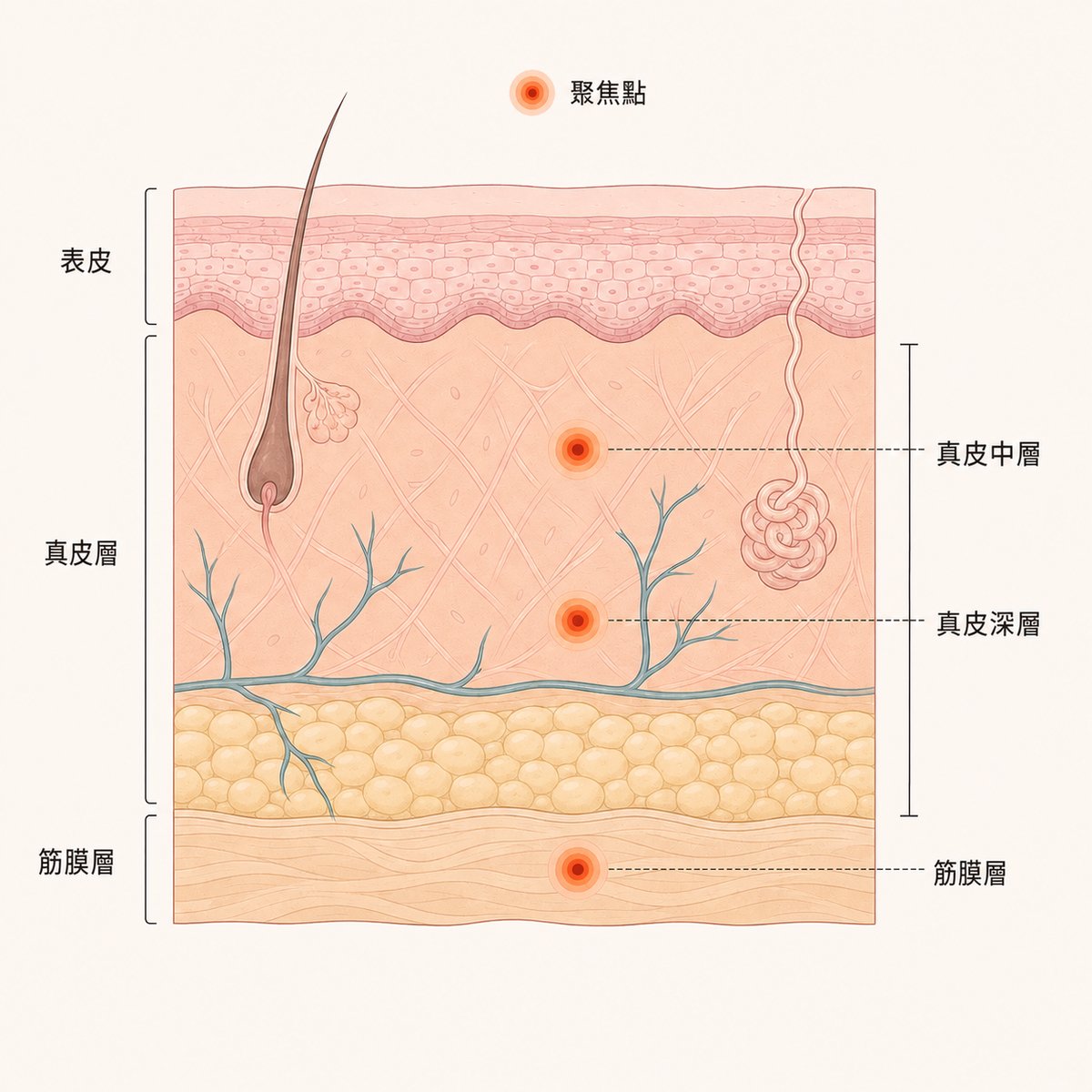 表皮、真皮層、筋膜層與各深度超音波熱凝固點示意圖