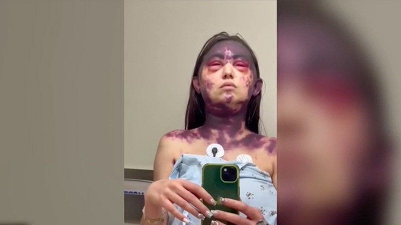 Update on Alexis Lorenze, 23-Year-Old Severely Injured After Hospital Forced Her to Get 3 Vaccines