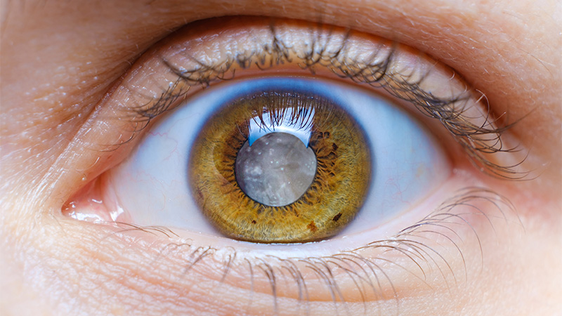 Link Between Cataracts and Vascular Dementia Found — Study