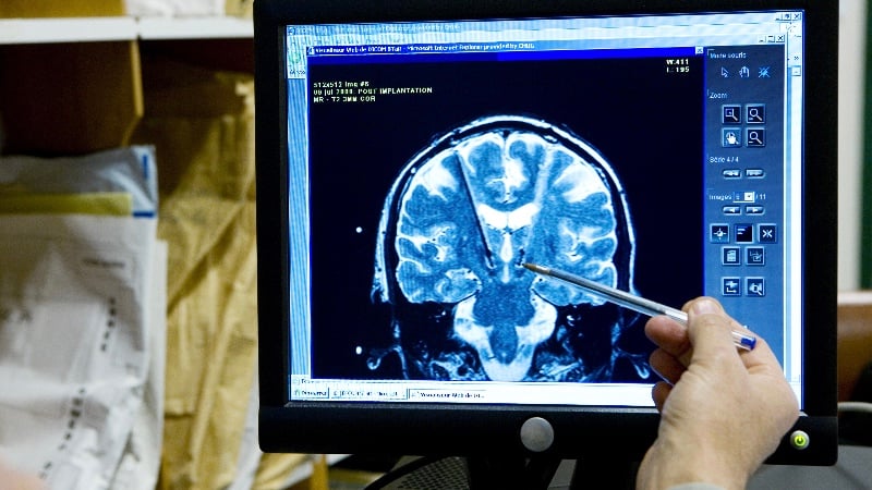 Medical Shocker: Anti-Psychotic Medications Shrink The Brain by 10 Percent, According to Peer-Reviewed Research and Whistleblowing Psychiatrist
