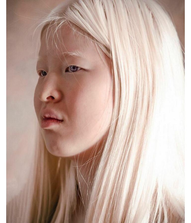 Abandoned as a baby in China because of the way she looked, this Albino ...