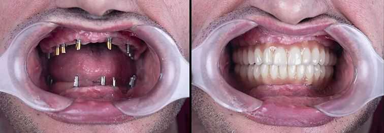 Vale la pena recarsi in Albania per gli impianti dentali?