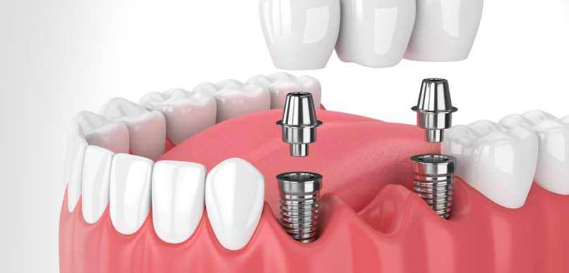 Vale la pena recarsi in Albania per gli impianti dentali?