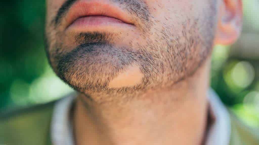 Les différents types de trous et de zones clairsemées dans la barbe
