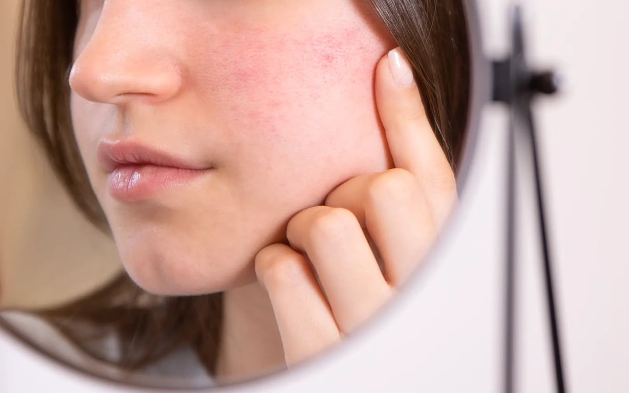 Peau apaisée et confortable — accompagner la rosacée au naturel — Cocoon d'Orient
