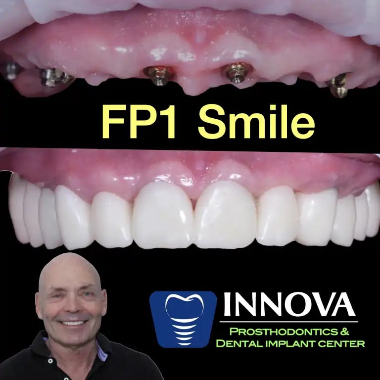 https://www.fp1smile.com/wp-content/uploads/2025/03/Fp1Smile-Innova-Prosthodontics-Implant-Teeth-DrRivera.webp
