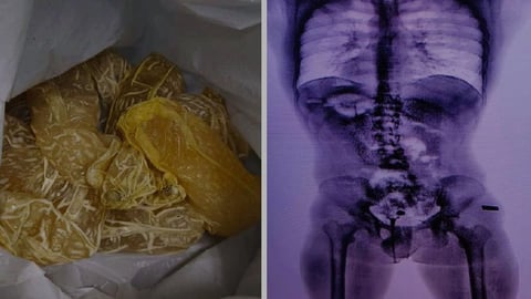 Aduana Cubana Detiene Pasajero con 25 Cápsulas de Droga Ingeridas