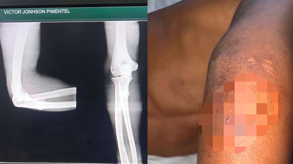 ¡Le fracturaron el brazo por robarle la moto en Camagüey! Casi lo matan a pedradas